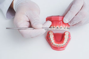 a doctor explaining dental braces tx process