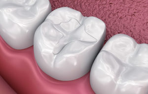 a rendering of dental fillings and sealants missouri city tx