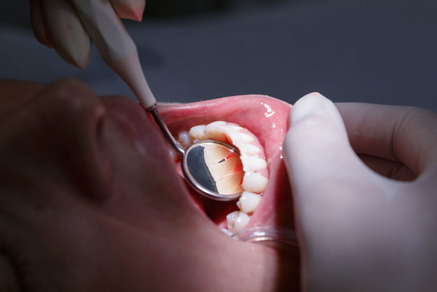 Causes of Receding Gums causes of receding gums