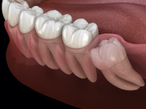 an impacted tooth pushes against other teeth, causing issues 