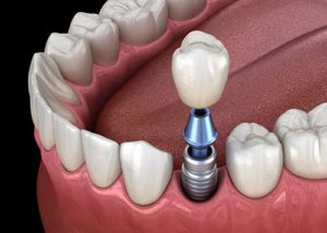 a simulation of dental implants being inserted