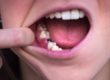 individual in need of a single tooth implant