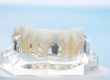 example of dental implants