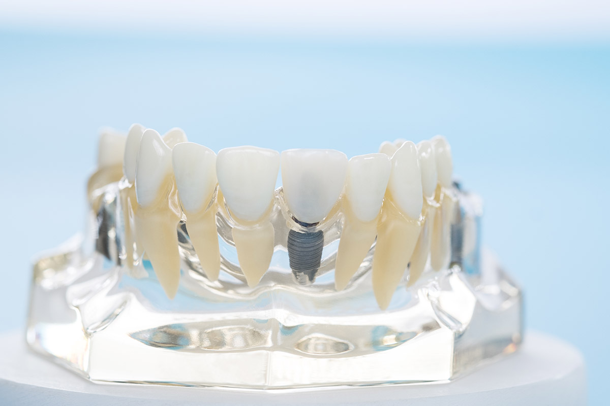 How Do Dental Implants Work_ example of dental implants